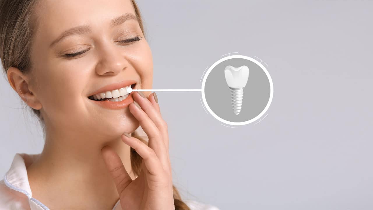 Dental Implants