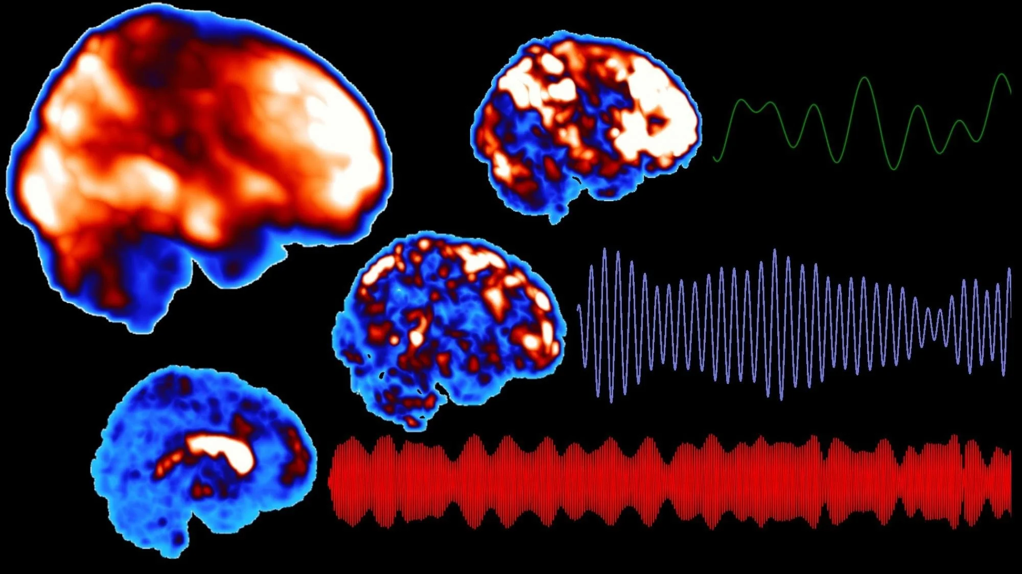 new treatment for narcolepsy