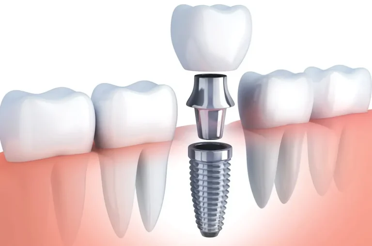 benefits-of-dental-implant